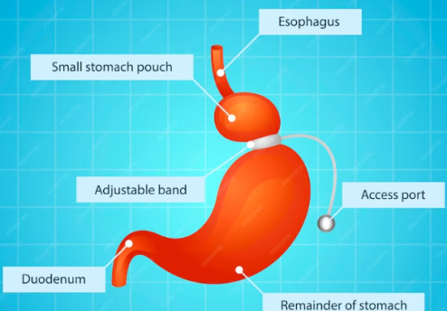 Gastric Band for Weight Loss