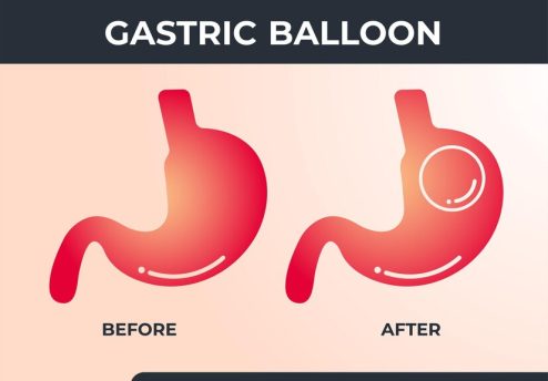 Gastric Balloon